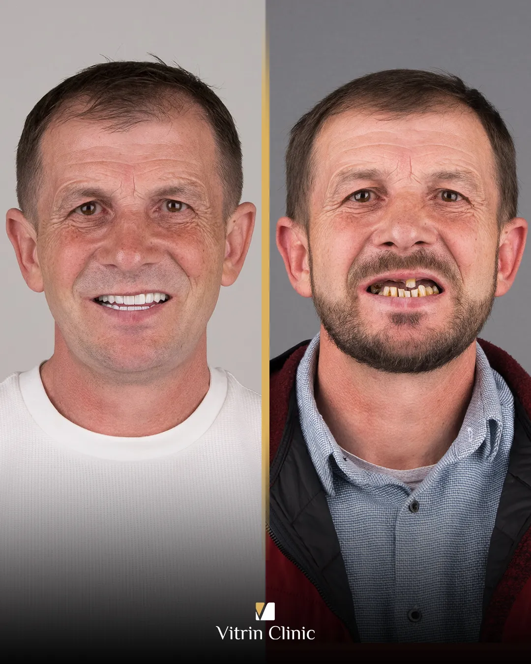 All on 4 Dental Implants4
